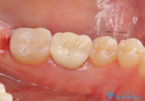 セラミックインレー 下の一番奥歯 歯ぐきの厚みを減らしてぴったりに入れます(ディスタルウェッジ+骨外科)の治療後