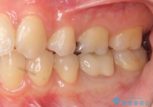 セラミックインレー 下の一番奥歯 歯ぐきの厚みを減らしてぴったりに入れます(ディスタルウェッジ+骨外科)の治療後