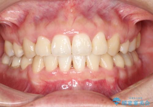 上下の歯のガタガタ　ワイヤーでの抜歯矯正で整った歯並びへの症例 治療後