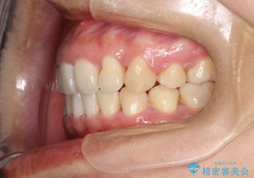 上下の歯のガタガタ　ワイヤーでの抜歯矯正で整った歯並びへの治療後