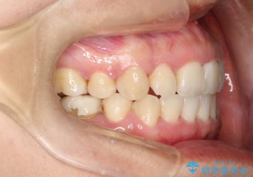 上下の歯のガタガタ　ワイヤーでの抜歯矯正で整った歯並びへの治療後