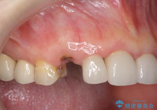 クラウン下に再発した深い虫歯 インプラントによる機能回復の症例 治療前