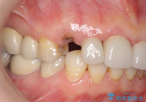 クラウン下に再発した深い虫歯 インプラントによる機能回復の治療前