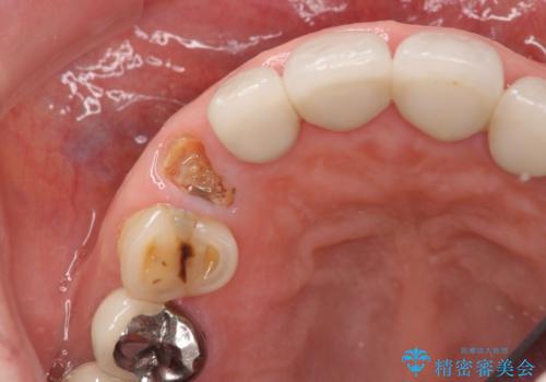 クラウン下に再発した深い虫歯 インプラントによる機能回復の治療前