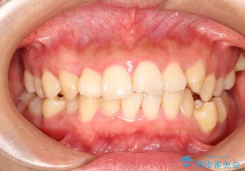 上下の歯のガタガタ　ワイヤーでの抜歯矯正で整った歯並びへの症例 治療前