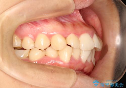 上下の歯のガタガタ　ワイヤーでの抜歯矯正で整った歯並びへの治療前