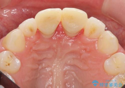 口ゴボでお悩みの方必見! 不自然なセラミックをやり直す矯正 セラミックだけでは、口元は下がりません。の治療中