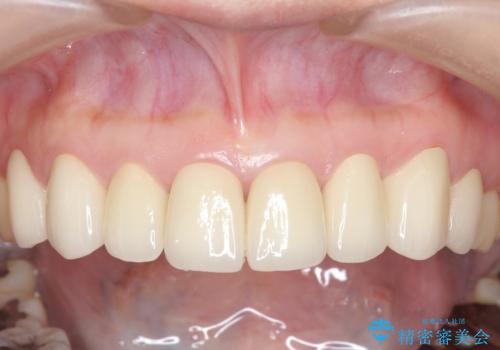 オールセラミッククラウン・セラミックインレー 口腔内全体の見た目の改善の治療後
