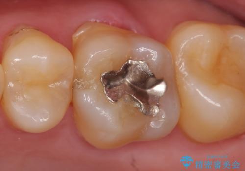 オールセラミッククラウン 精密根管治療~神経が死んでしまった歯の治療~の症例 治療前