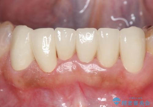 オールセラミッククラウン・セラミックインレー 口腔内全体の見た目の改善の治療後