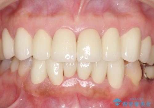 オールセラミッククラウン・セラミックインレー 口腔内全体の見た目の改善の治療後
