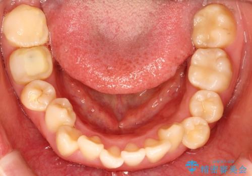 上下の歯のガタガタ　ワイヤーでの抜歯矯正で整った歯並びへの治療前