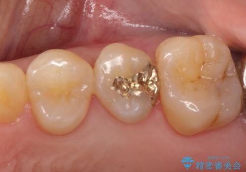 虫歯の治療。ゴールドインレーによる治療の治療後