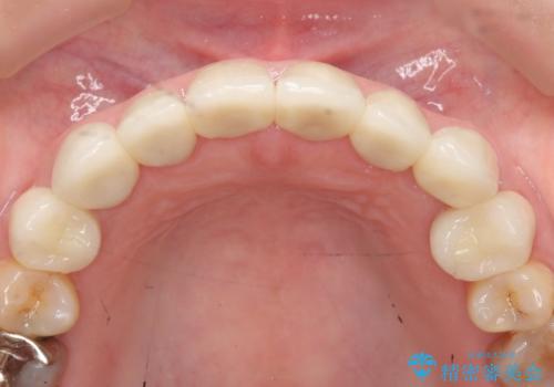 オールセラミッククラウン・セラミックインレー 口腔内全体の見た目の改善の治療後