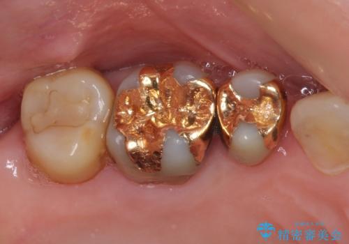 奥歯の深い虫歯をオールセラミックで治療の治療前