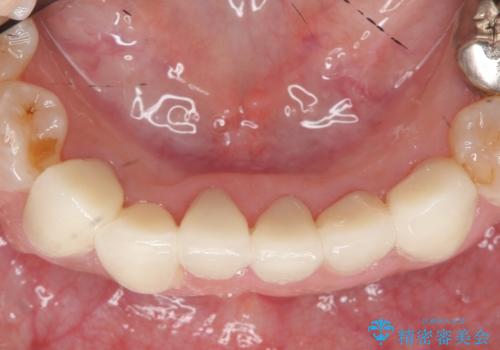オールセラミッククラウン・セラミックインレー 口腔内全体の見た目の改善の治療前