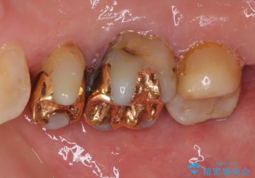 奥歯の深い虫歯をオールセラミックで治療の治療前