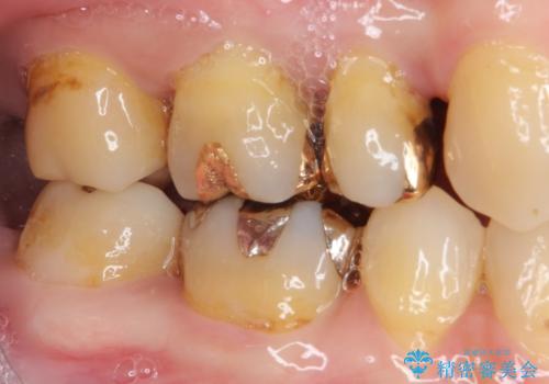 奥歯の深い虫歯をオールセラミックで治療の治療前