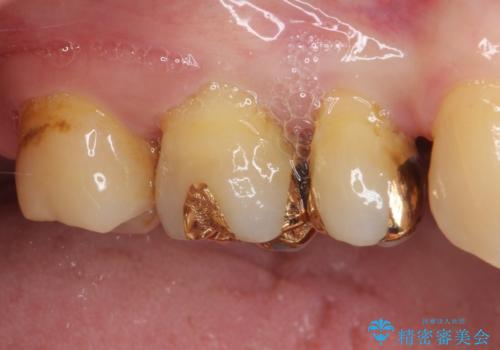 奥歯の深い虫歯をオールセラミックで治療の治療前