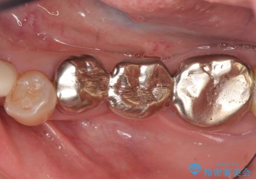 オールセラミッククラウン・セラミックインレー 口腔内全体の見た目の改善の治療前