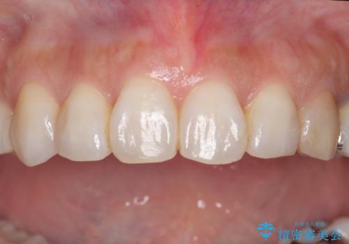 犬歯の変色 マウスピースで手軽にエクストリュージョン 歯ぐきの炎症をおさめますの治療前