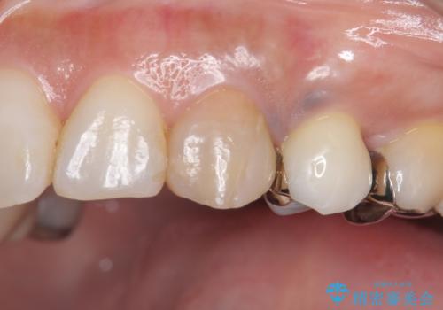 犬歯の変色 マウスピースで手軽にエクストリュージョン 歯ぐきの炎症をおさめますの症例 治療前