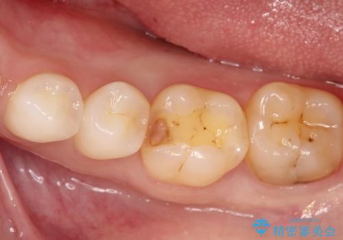 詰め物が外れた セラミックによる精密な修復の治療中