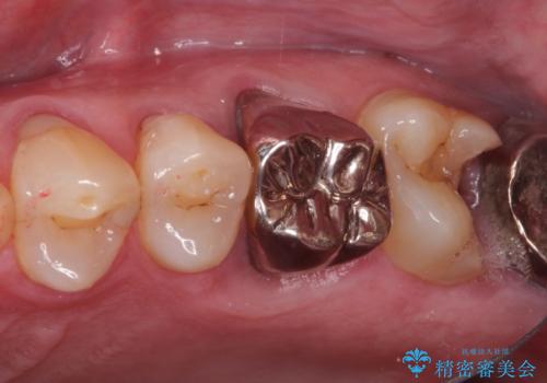 ゴールドインレーによる修復治療の症例 治療前