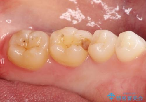 詰め物が外れた セラミックによる精密な修復の治療中