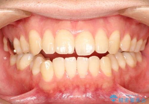 前歯でものが噛み切れない インビザラインによるオープンバイトの治療の治療前