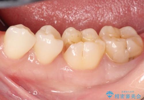 詰め物が外れた セラミックによる精密な修復の治療中