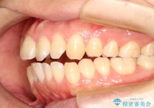 前歯でものが噛み切れない　インビザラインによるオープンバイトの治療の治療前