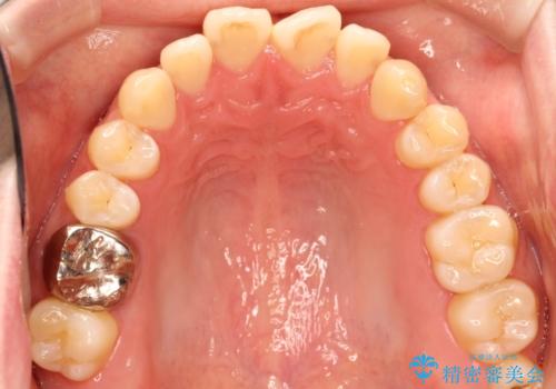 前歯でものが噛み切れない　インビザラインによるオープンバイトの治療の治療前
