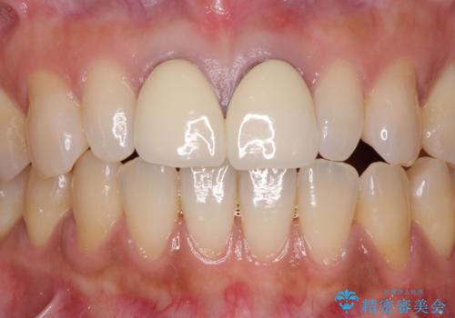 前歯をメタルフリーに　根管治療で不安を取り除いてからの治療前
