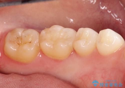 詰め物が外れた セラミックによる精密な修復の治療後