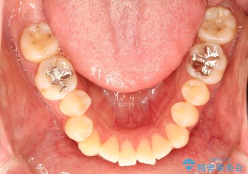 前歯でものが噛み切れない インビザラインによるオープンバイトの治療の治療前