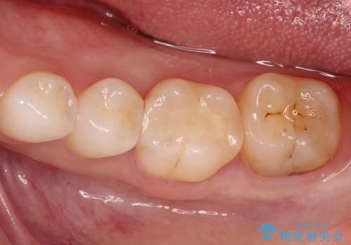 詰め物が外れた セラミックによる精密な修復