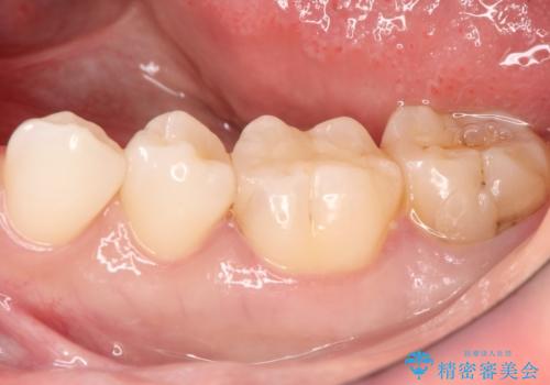 詰め物が外れた セラミックによる精密な修復の症例 治療後