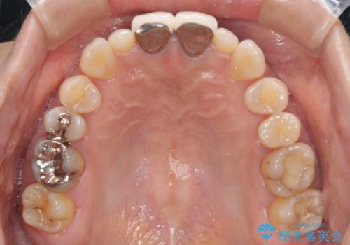 前歯をメタルフリーに　根管治療で不安を取り除いてからの治療前