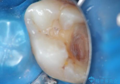 ゴールドインレーによる修復治療の治療中