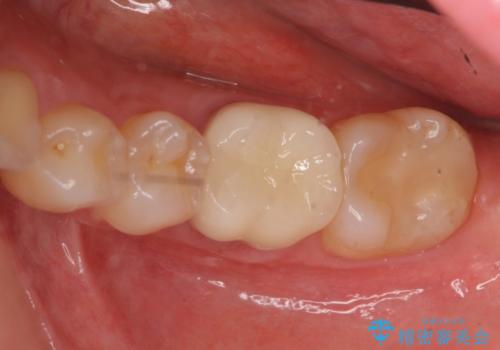 セラミックインレー 下の一番奥歯 歯ぐきの厚みを減らしてぴったりに入れます(ディスタルウェッジ+骨外科)の治療中