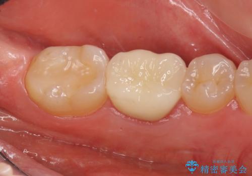 セラミックインレー　下の一番奥歯　歯ぐきの厚みを減らしてぴったりに入れます(ディスタルウェッジ+骨外科)の治療中