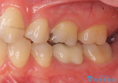 セラミックインレー 下の一番奥歯 歯ぐきの厚みを減らしてぴったりに入れます(ディスタルウェッジ+骨外科)の治療中