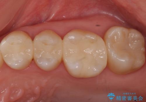 3本仮づめのまま放置 セラミックインレーへの治療後