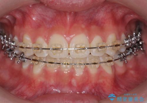 受け口 親知らずを取り込む矯正治療の治療中