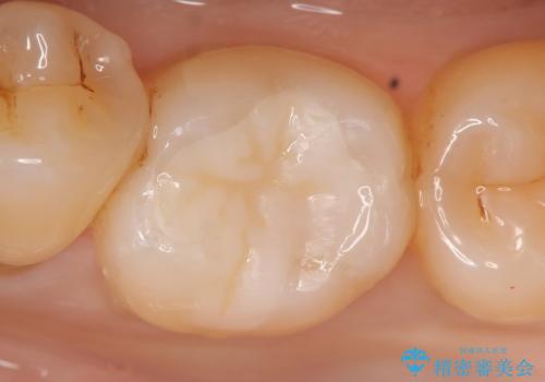 セラミックインレー しみる古い樹脂のやり替えの症例 治療後