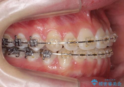 受け口 親知らずを取り込む矯正治療の治療中