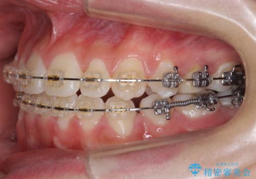 受け口 親知らずを取り込む矯正治療の治療中