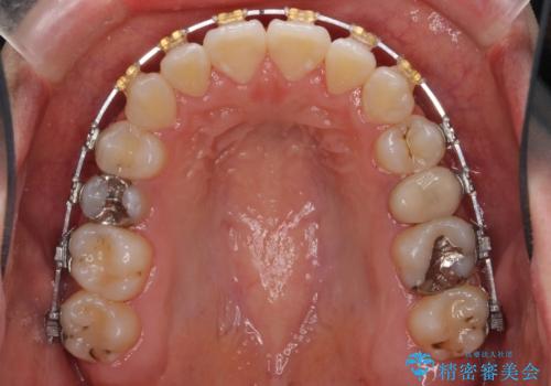 受け口 親知らずを取り込む矯正治療の治療中