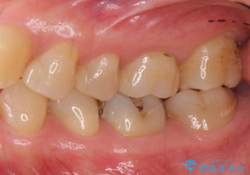 3本仮づめのまま放置 セラミックインレーへの治療後